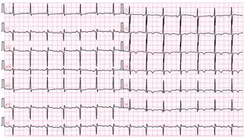 病理性q波的鉴别诊断