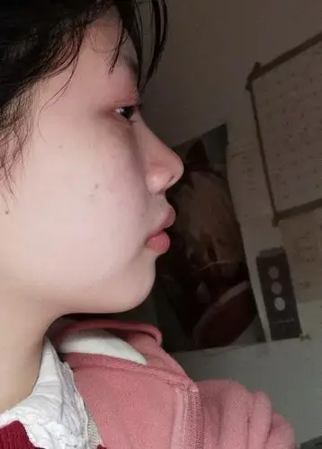 我这样算嘴突吗01还是单纯的嘴唇厚