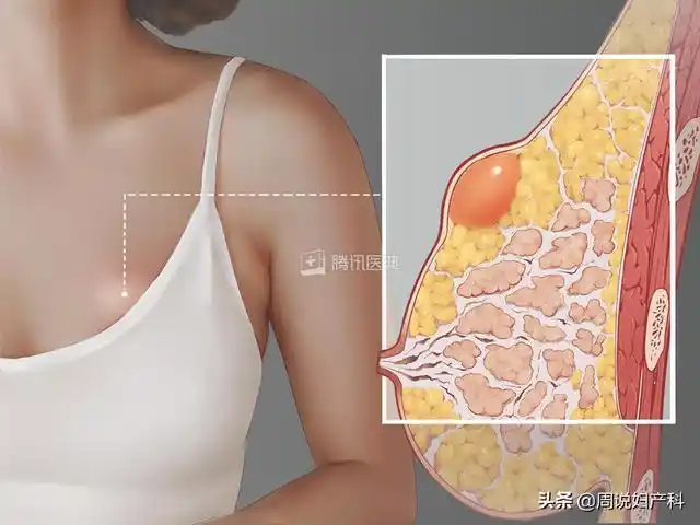 摸到乳房有肿块,别慌!记得先做这件事|乳腺|囊肿|增生|乳头|乳腺癌_网