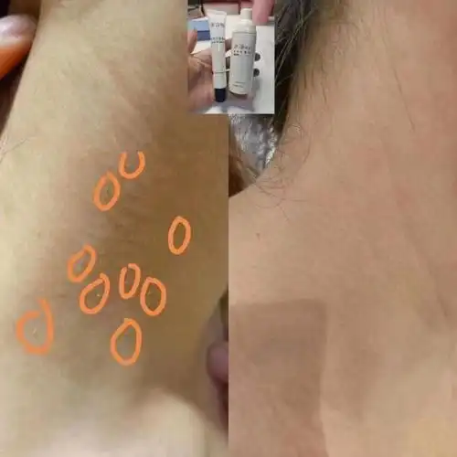 脖子上的丝状疣