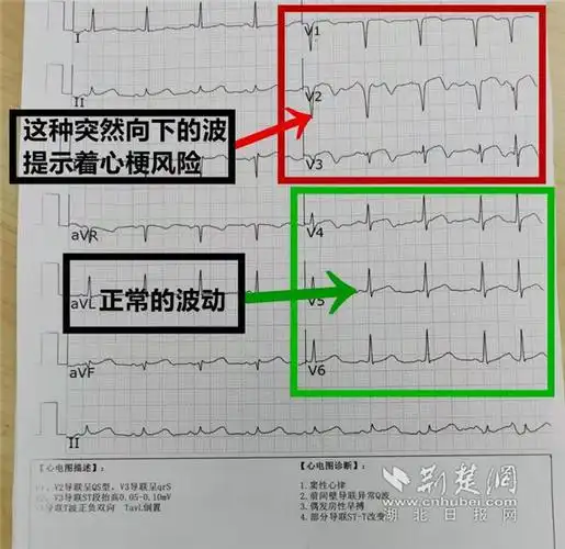 "心电图上v1-v3的波浪线提示着心脏前间壁的健康状况.