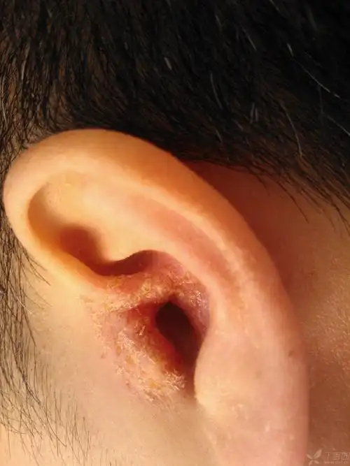 【求助】左耳廓内则破溃后,皮肤瘙痒,反复不愈 - 皮肤性病 -丁香园