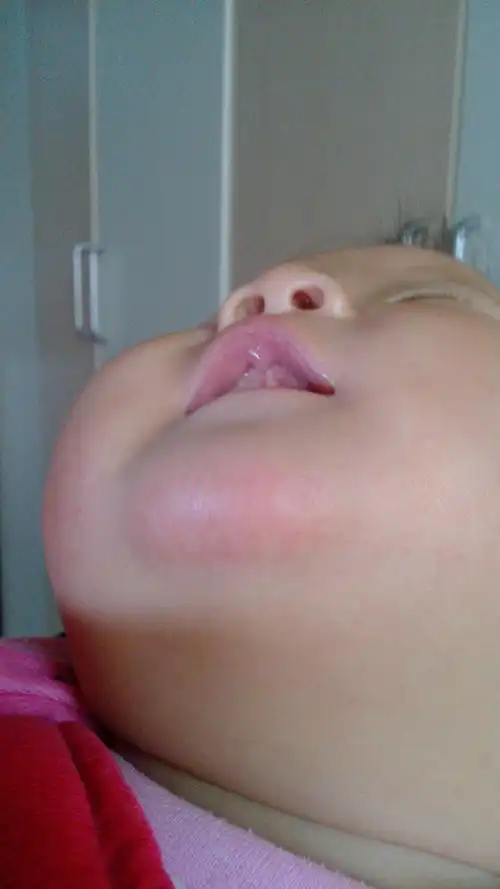 如题  下巴和脸蛋有点红皮肤发干,  宝宝不流口水.