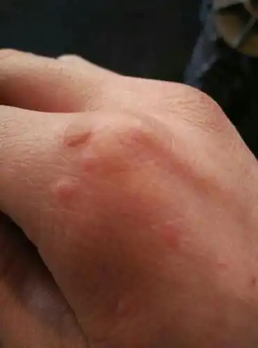 现在两只手背起了好多,胳膊上也有,偶尔会有发痒,是扁平疣