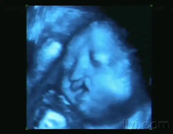 胎儿唇裂三维图像