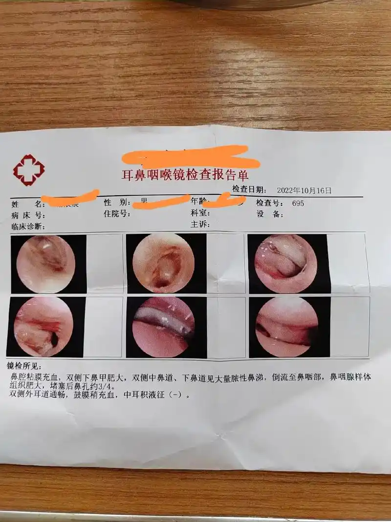 孩子的腺样体肥大,张嘴呼吸 - 抖音