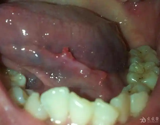 女性口腔尖锐湿疹初期图片_口腔尖锐湿疣_鬼臼毒素软膏治口腔湿疣