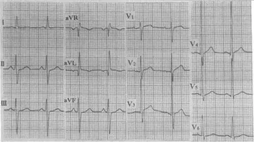 【定义】 发生于左前分支上的传导延缓或传导中断,称为左前分支阻滞