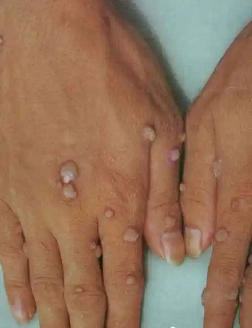 病毒性皮肤病—疣