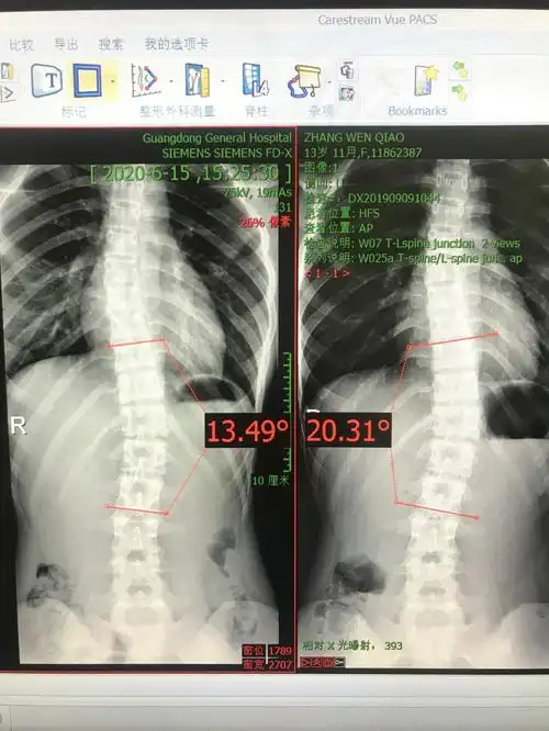 如何挑选等)_脊柱侧弯_介绍_治疗方式_日常注意事项 - 好大夫在线