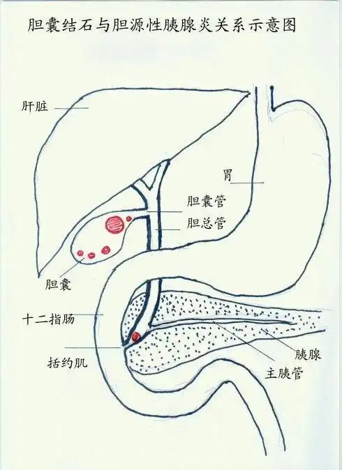 胆结石引起的急性胰腺炎怎么办?