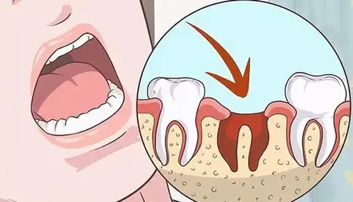 拔智齿洞恢复过程14天图解(拔牙7天恢复图解详情)