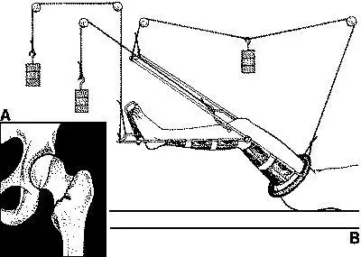 还有叫兽建议那些移位的股骨颈骨折病人,回家外展牵引,重新做一遍血泪