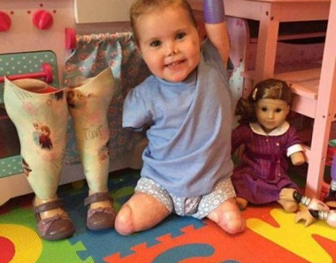 英国被截去四肢的小女孩感到很孤单,父母为她订做了礼物