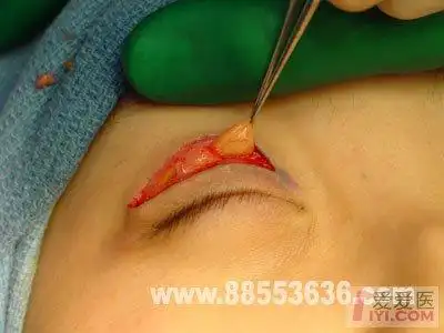 【转贴】【资源】eleven mm切开双眼皮手术过程全记录