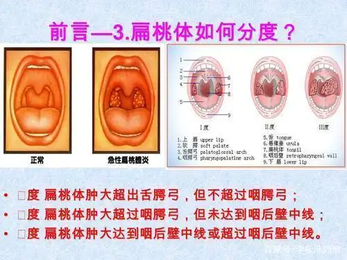 第三就是扁桃体手术之后有些容易复发,如果扁桃体手术不彻底,那么