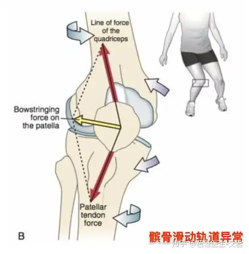 损伤:髌骨滑动轨迹偏离正常轨迹,会撞击到股骨髁引起疼痛,时间长了会