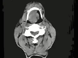 会厌癌c.声带癌d.声门下区癌e.跨声门型癌点击查看答案进入题库练习