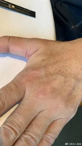 昨天杭州渐冻症患者家属,告诉我患者虎口萎缩地方长肉肉了,可能是