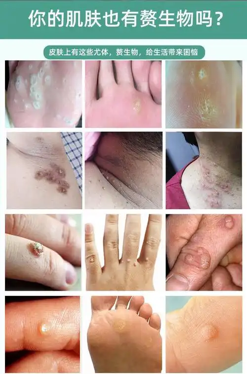 【买1送1】广雅 优肤平抑菌液 10ml 脸上肉粒面部扁平疣药膏寻常疣