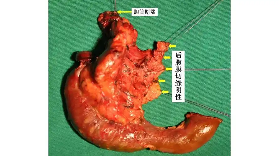 根治性胰十二指肠切除术治疗壶腹周围癌胆管远端癌乳头癌胰腺癌