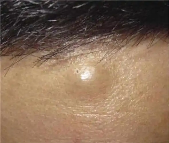 额头脂肪瘤特征图片