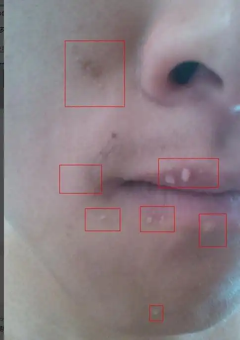 脸部和嘴唇长有白色的小痘痘,一年多了近两年还没有消除,有图.