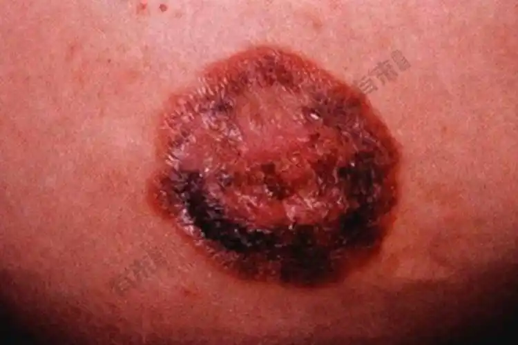 乳房湿疹样癌初期症状图片