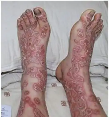 世界十大最恶心皮肤病皮肤蝇蛆病就是莲蓬乳图