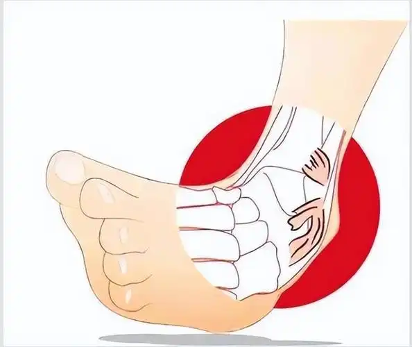 习惯性崴脚应该怎么去调养(不小心崴脚咋办)(3)