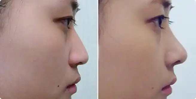 梁奕敏自体脂肪隆鼻需要多少费用自体脂肪隆鼻案例效果对比图上海交通