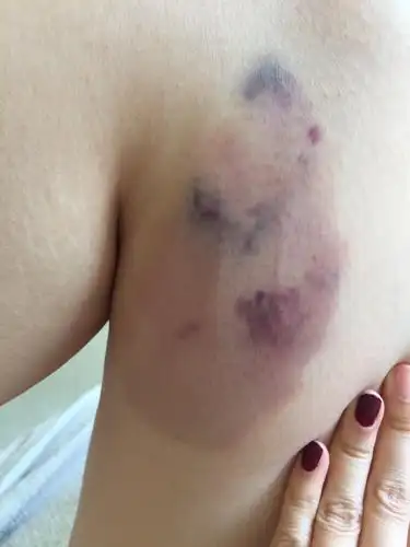 腿上有大片淤青要怎呢快速去除?贴土豆片还是香蕉?请高人指点下