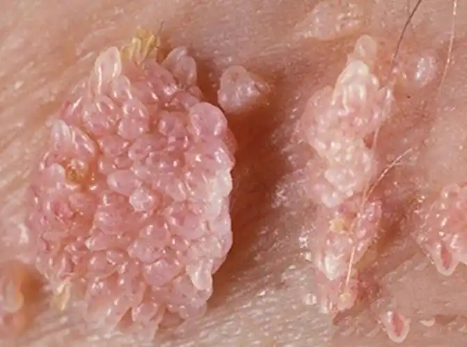 菜花状肛门尖锐湿疣图片