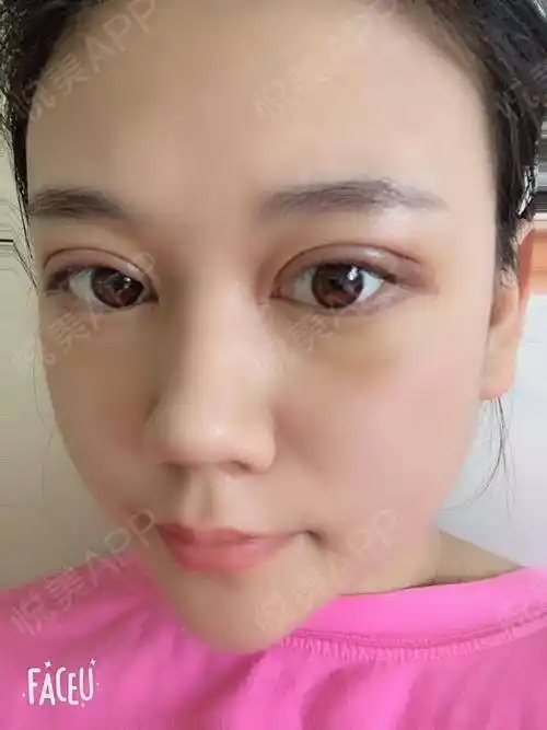 全切双眼皮术后8天_双眼皮术后8天_眼部整形术后8天_夜星辰分享图片11