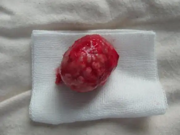 下颌部囊肿---表皮样囊肿