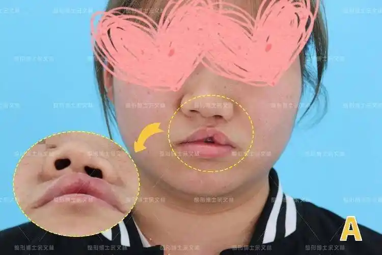 案例分析唇裂术后出现口哨样畸形19岁女生做手术改善