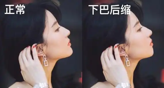 当刘亦菲的下巴变成"后缩"下巴.