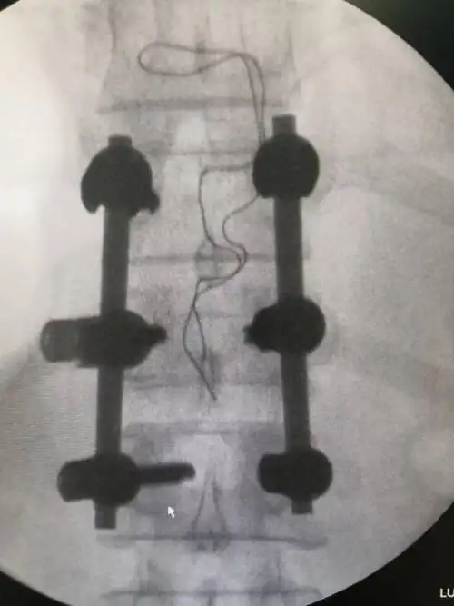 胸椎压缩骨折切开复位钉棒内固定术