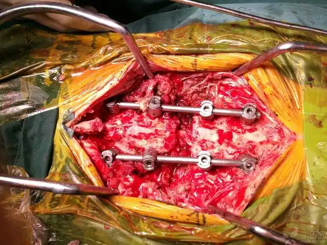 腰椎骨折合并有强直性脊柱炎 [病例帖]