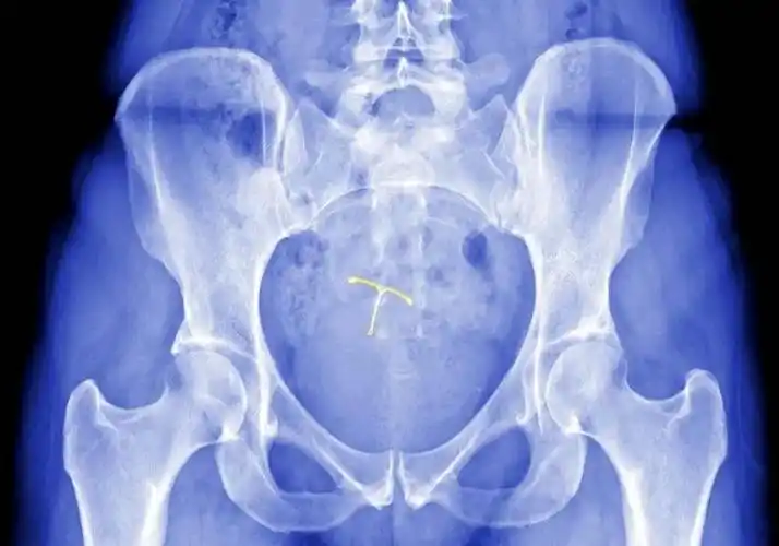 【女性健康】上节育环好吗?对子宫会有什么影响呢?