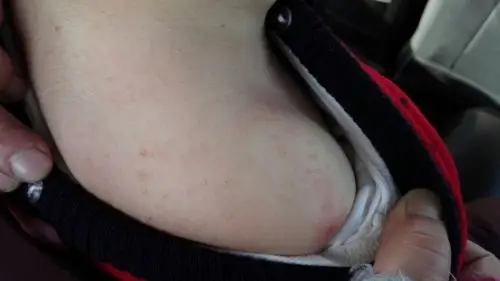 宝宝得了传染性软疣,有没有人有好的小偏方!急急急