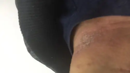 大腿根部,都有红的一片,还有脖子,结痂,很痒,腹股沟处有黏黏的液体很