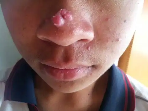 我儿子15岁,鼻子尖上长个很大的痤疮都没办法消掉,要咋治疗呢?