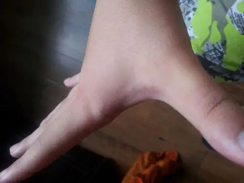 天虎口肌肉跳动比较频繁,发现左手虎口有个疑似凹陷希望看看是否萎缩