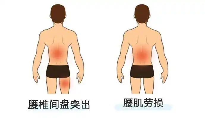 腰肌劳损:疼痛主要集中在腰部,偶尔累及臀部,腿部尤其是膝关节以下