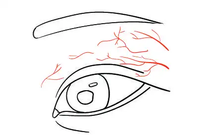 外眼皮红血丝图片