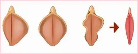 女性尿道两边肉特别长有什么影响吗?需要做手术切掉吗?