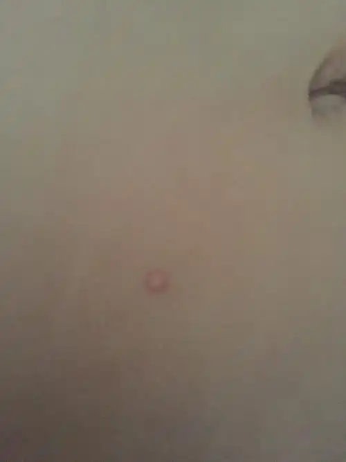 孩子快2岁了,肚子上和小鸡鸡上涨了几个透明状小包,还不断长大,怎么