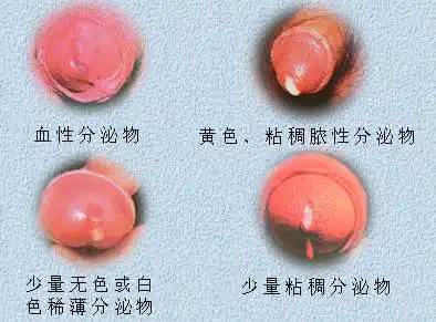 龟头炎症状对照图片