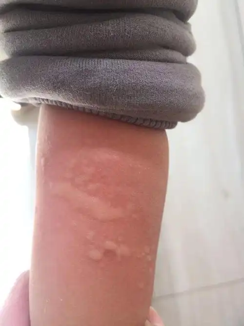 2岁宝宝身上起了包,受冷就出现,一抓就扩散,热了就自动消失,这是怎么